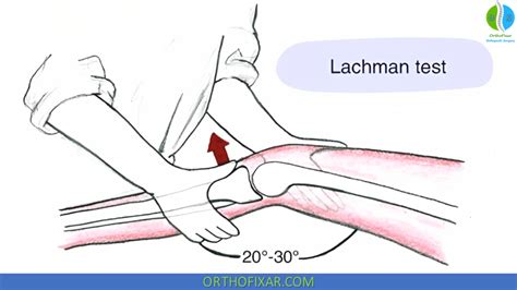 test for ligament tear|lachman test positive sign.